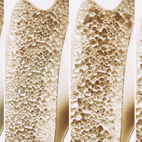 Csontritkulás: miért nem elég önmagában a kalcium